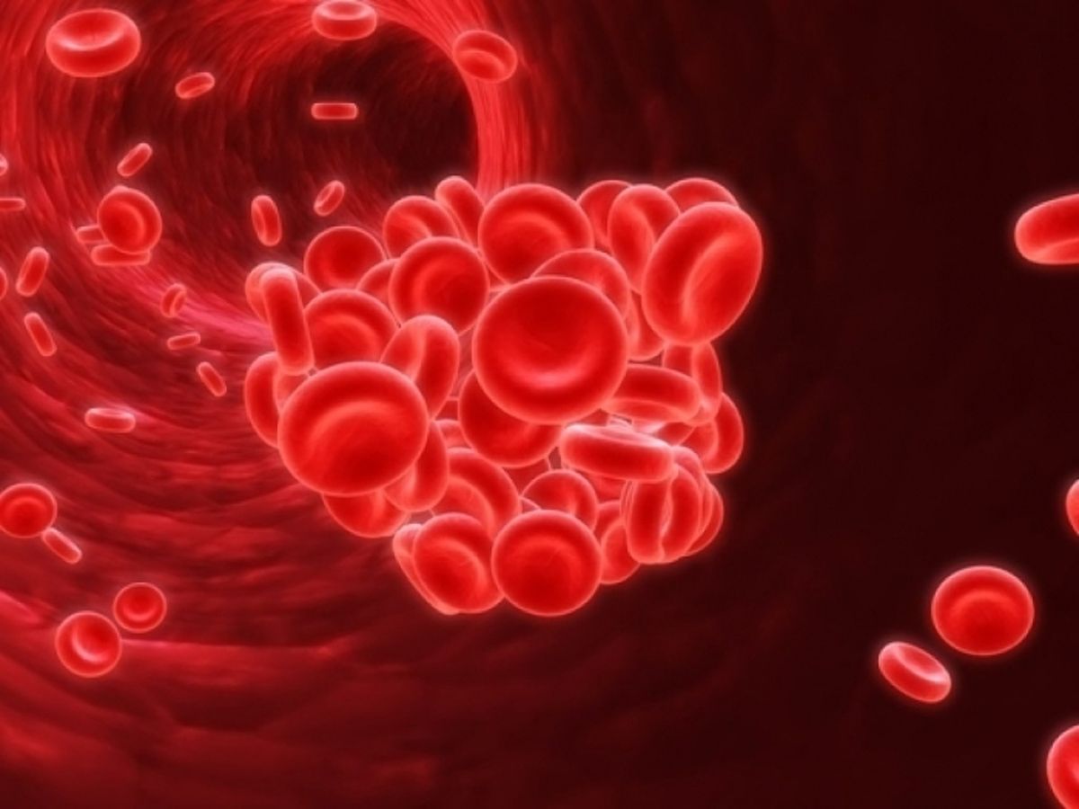 Как проводится катетерное растворение кровяных сгустков
